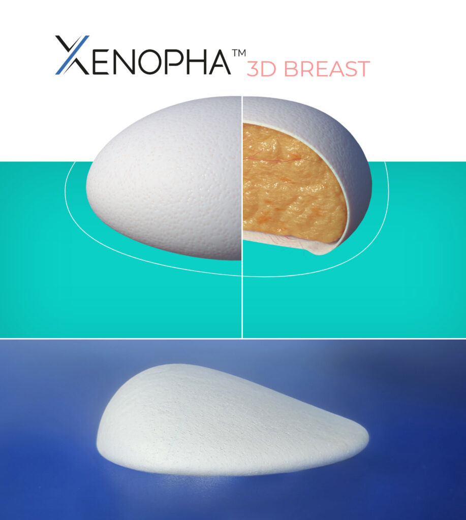 Illustration de la prothèse mammaire Xenopha 3D Breast